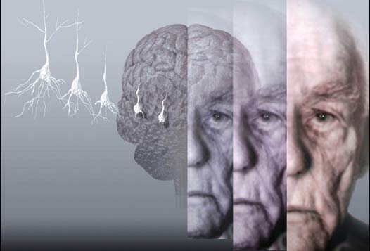 alzheimer-15